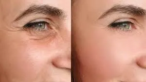 Armonización facial y neuromoduladores: precisión estética sin promesas